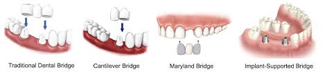 Different types of dental bridges pictures