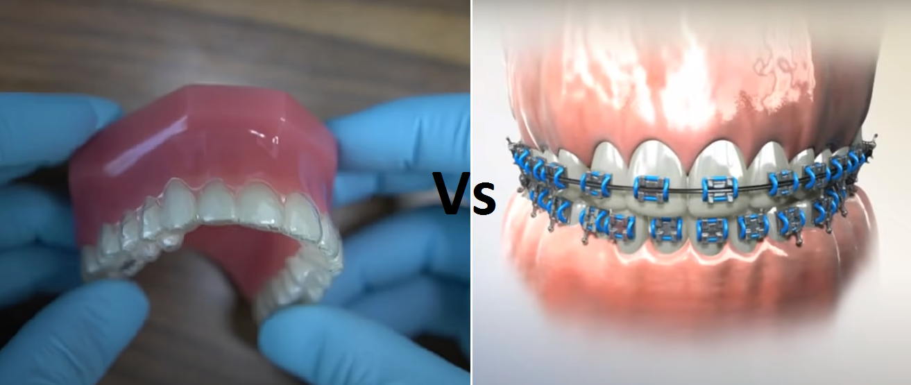 Invisalign vs braces: which is faster?