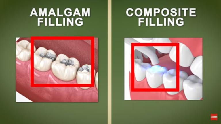 amalgam vs composite filling
