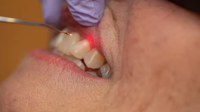 laser for periodontal disease