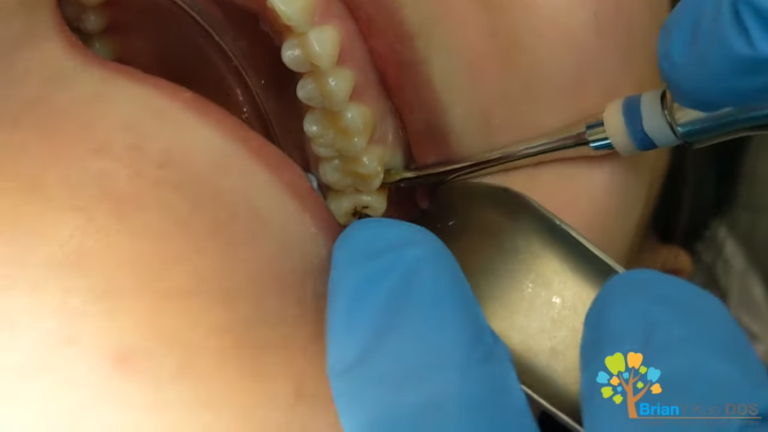 upper molar extraction complications