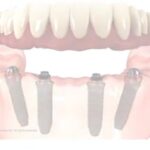 Disadvantages of mini dental implants