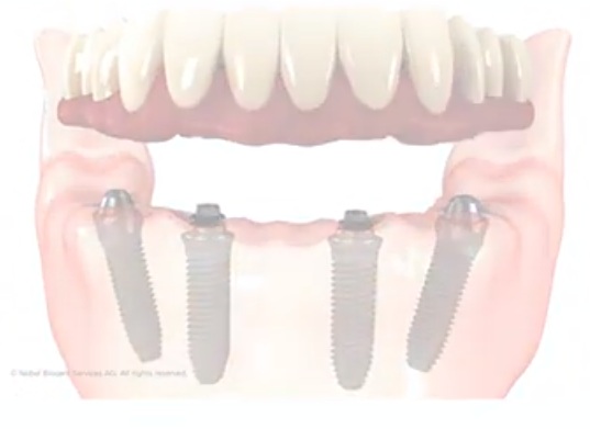 Disadvantages of mini dental implants