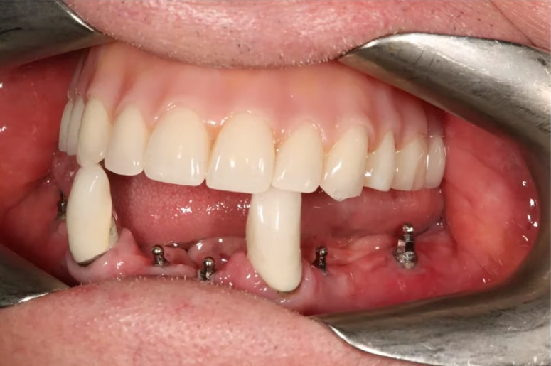 Mini implants for lower dentures