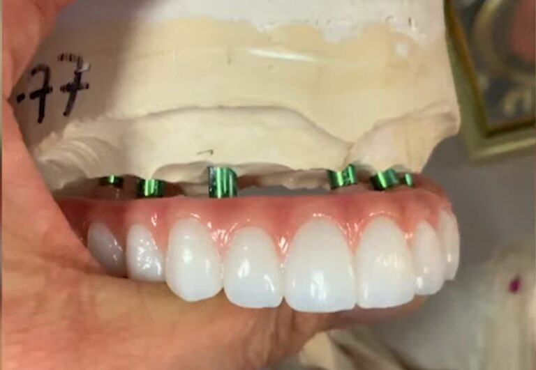 Alternative to dentures with gum disease