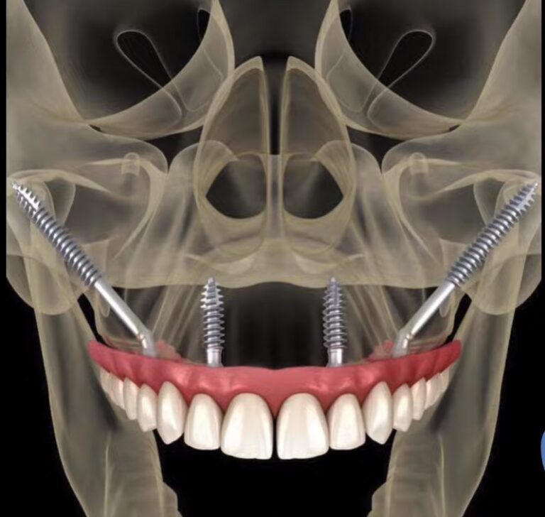 Zygomatic implants pros and cons