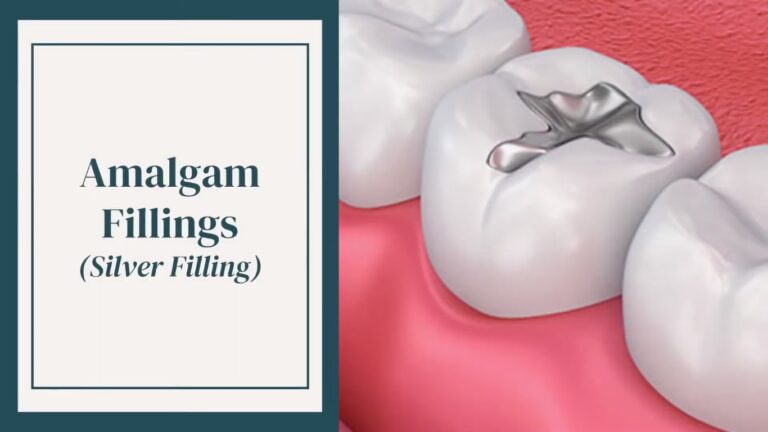 4 Types of Fillings