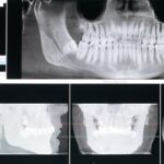 Do dental X rays show cancer