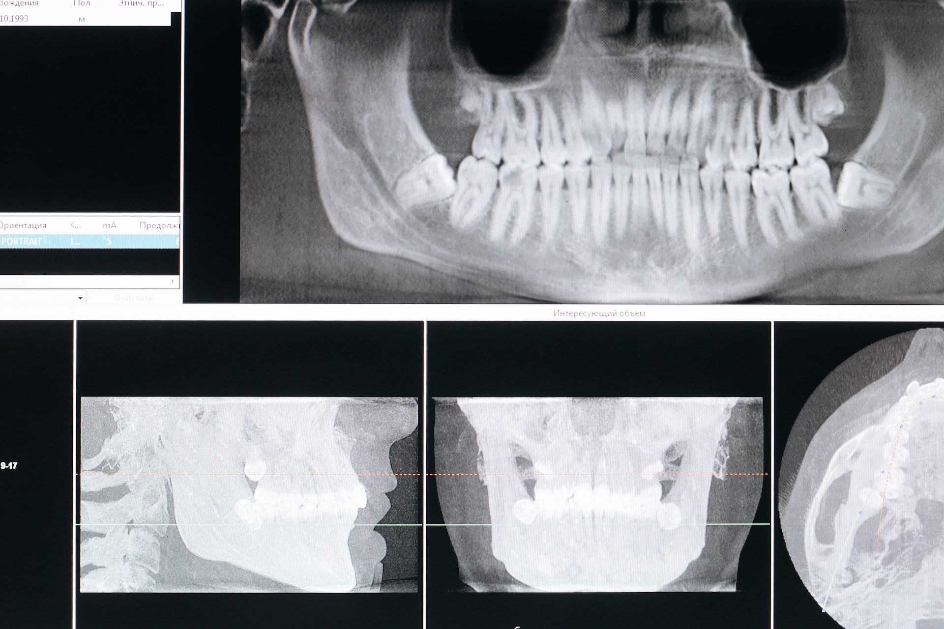 Do dental X rays show cancer