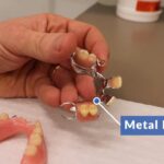 Cobalt chrome vs. acrylic denture